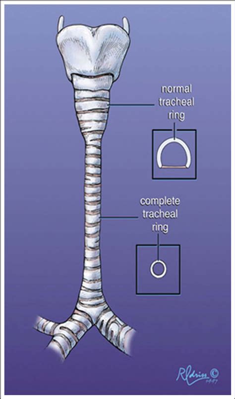 Figure 1 From A History Of Pediatric Tracheal Surgery Semantic Scholar