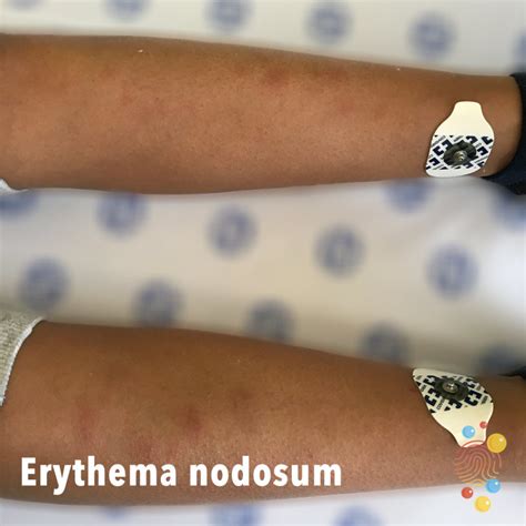 Erythema Nodosum Skin Deep