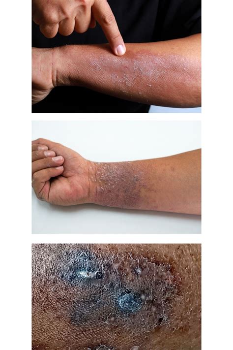 Eczema On Dark Skin Cleure
