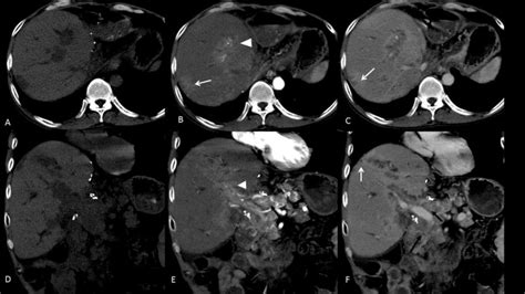 Ct Triple Phase Liver Angiography Images On Plain A And D Arterial