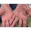 What Causes Psoriasis On Hands  Dorothee Padraig South West Skin