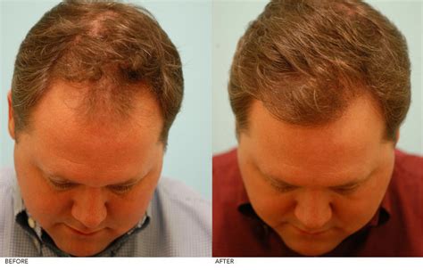 Numerous classification systems have been proposed by various researchers for grading purposes. Male Pattern Baldness Dallas, Androgenetic Alopecia Plano ...
