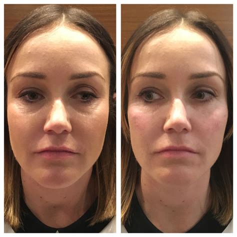 Dermal Filler Cheeks Wellington Road Dental Care