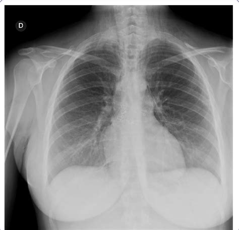 Chest X Rays Showing Pneumomediastinum And Subcutaneous Emphysema