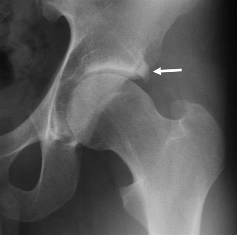 Simple Radiographic Classification Of Femoroacetabular Impingement A My XXX Hot Girl