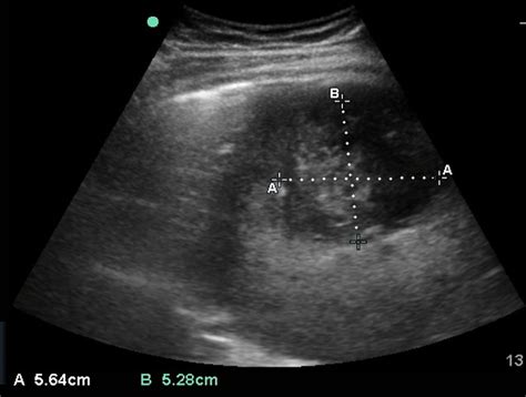 Liver Abscess Critical Care Sonography
