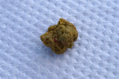 Why Is Gallstone Flushing Dangerous Med Scoop Daily