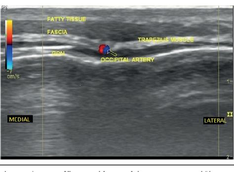 Figure 1 From Ultrasound Guided Greater Occipital Nerve Blocks And