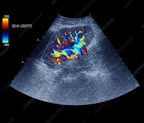 Transplanted Kidney Doppler Ultrasound Stock Image M1950142
