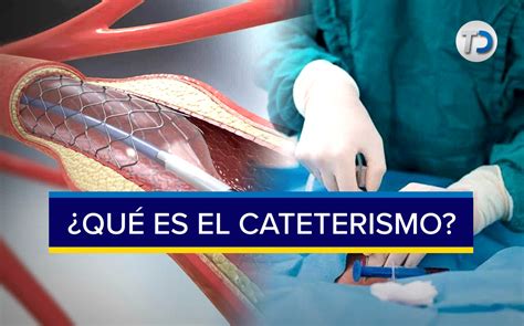 Cateterismo Cardiaco Qué Es Y Por Qué Se Realiza Telediario México