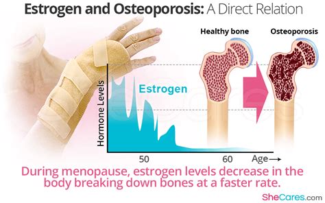 Estrogen And Osteoporosis A Direct Relation Shecares