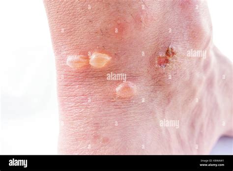 Closeup Of Ankle With Blisters Stock Photo Alamy