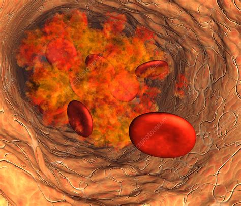 Blood Clot Stock Image P2600072 Science Photo Library