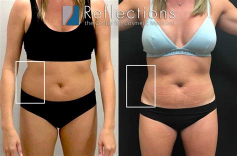 Vaser Lipo For Love Handles And Hips Before And After Photos New Jersey Reflections Center