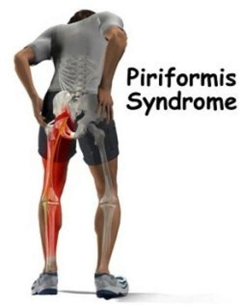 Piriformis Syndrome How To Manage The Pain For The Time Being