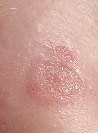 Doctor Says Its A Yeast Infection In My Armpitunderarm Area Thoughts