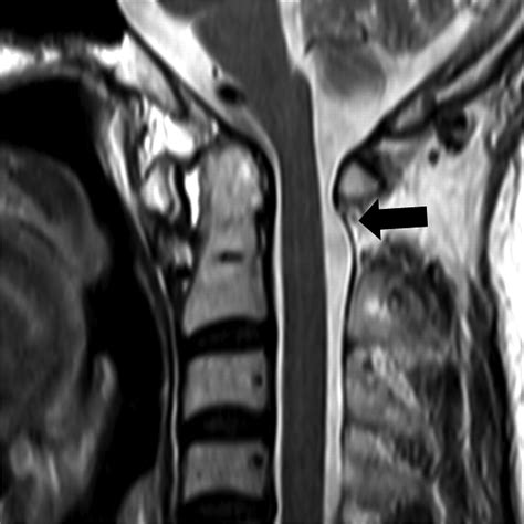 Revisiting Anterior Atlantoaxial Subluxation With Overlooked