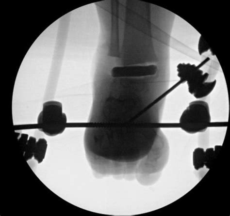 Staged Surgical Intervention In The Treatment Of Septic Ankle Arthritis