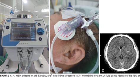 Figure 1 From Early Experience Of Automated Intraventricular Type