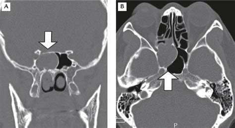 Figure From Isolated Inverted Papilloma Of The Sphenoid Sinus