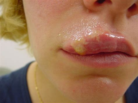 Herpes simplex is a viral infection caused by the herpes simplex virus. Oral Herpes - Dr. Joel Wallach | | Info Health News ...