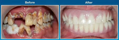 How To Repair Bad Teeth Schopmeyer Kishaba99