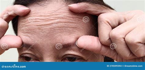 The Flabby Skin Wrinkles And Ptosis Beside The Eyelid Forehead Lines