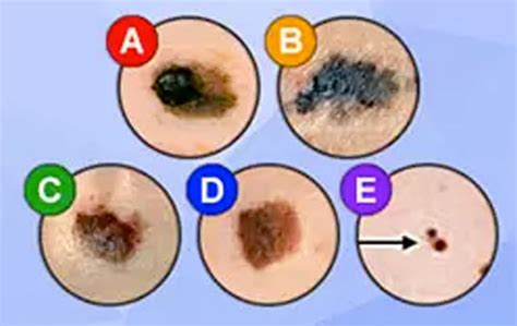 Skin Cancer Melanoma Bergen Dermatology Specialists