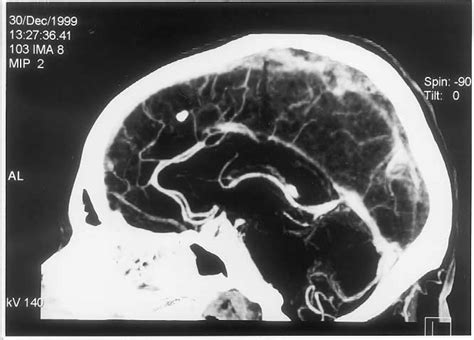 Ct Angiography Demonstrates Cvt Of The Superior Sagittal Sinus
