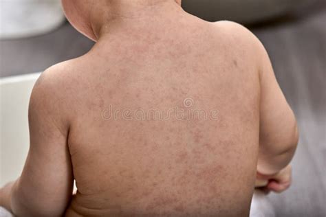 Roseola Rash A Viral Rash On The Skin Of A Child Stock Photo Image Of