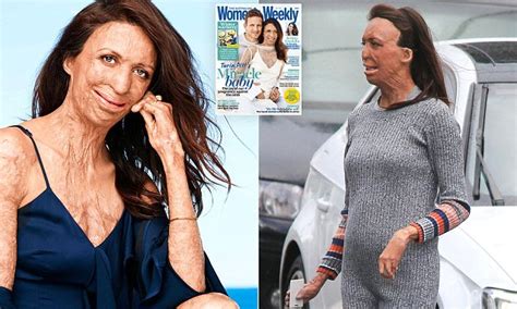Turia Pitt Talks About Her Pregnancy With Women S Weekly Daily Mail Online