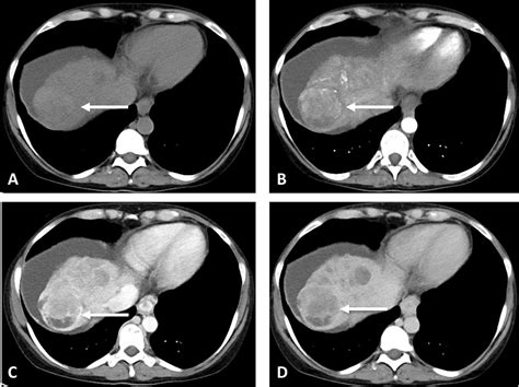 Hepatocellular Carcinoma State Of The Art Imaging And Recent Advances