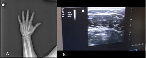 Figure From Ultrasound Guided Ulnar Nerve Block For Boxer Fractures