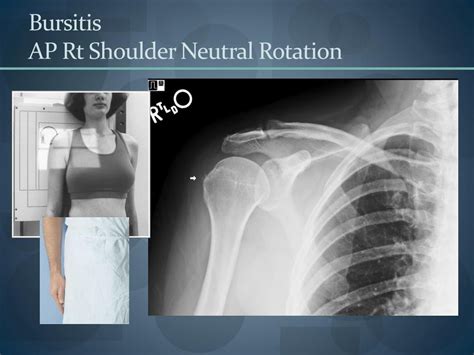 Shoulder Ap Neutral X Ray Polymed Lab