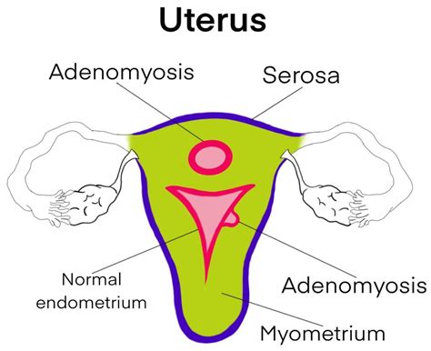 Diagnostics Free Full Text Adenomyosis And Its Possible Malignancy