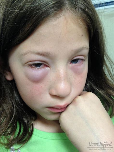 6 Ways To Help Kids Beat Seasonal Allergies Overstuffed