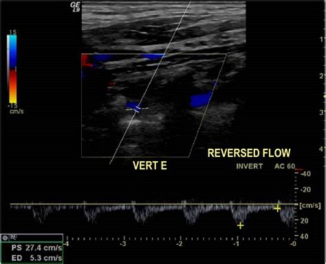 Figure 2 From An Update On Doppler Ultrasound Of Vertebral Arteries