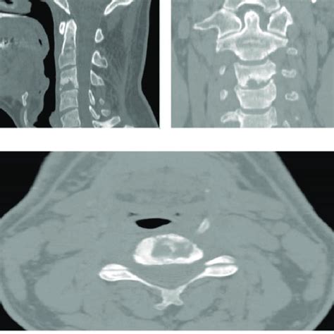 Ct Scan Of The Cervical Spine In The Sagittal Coronal And Axial Plane