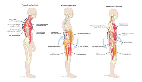 The transversospinales muscles go from transverse processes to spinous processes occupying the. 17 Back Muscles That Cause the MOST Back Pain (and how to ...