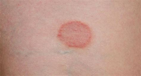 Ringworm Symptoms Causes Diagnosis And Treatment Natural Health News