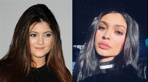 Kylie Jenner Opens Up About Plastic Surgery And Reveals The Real Reason
