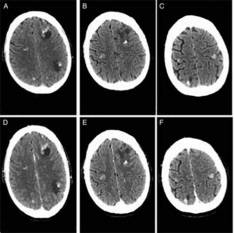 Multiple Calcified Brain Metastases In A Man With Invasive Ductal