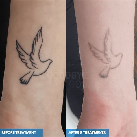 Is It Easier To Remove Old Or New Tattoos Goodbye Tattoos