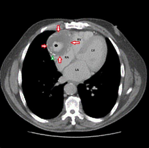 Cureus Giant Right Coronary Artery Aneurysm A Case Report
