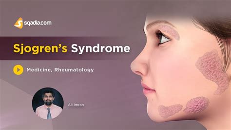 Sjogrens Syndrome Rheumatology Medicine Lectures Medical Education