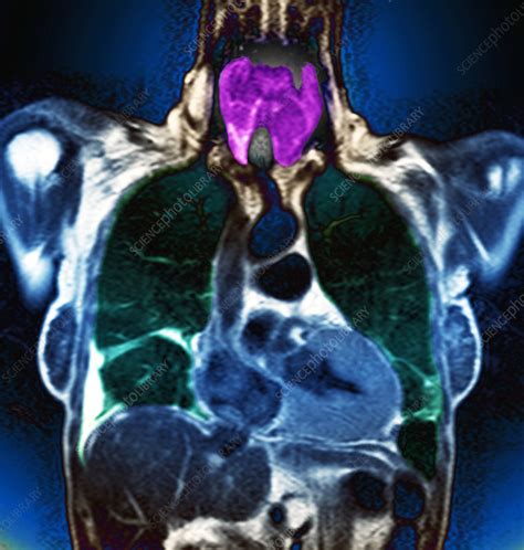 Swollen Thyroid Gland Mri Scan Stock Image M1650295 Science