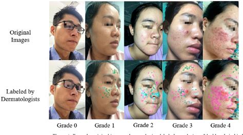 Figure 1 From Automatic Acne Object Detection And Acne Severity Grading