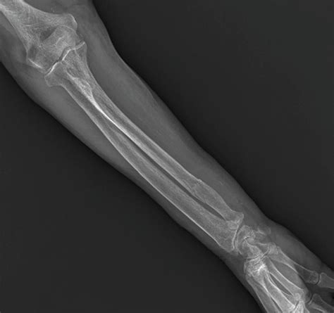 Fractured Ulna Arm Bone Photograph By Zephyrscience Photo Library