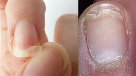 Top 10 Most Common Nail Diseases And Disorders Promed Clinic