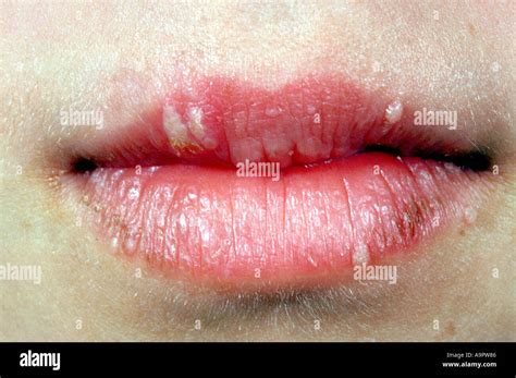 Les Boutons De Lherpès Sur Les Lèvres Photo Stock Alamy